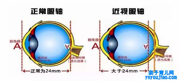 工钱什么会近视,近视眼形成的道理是什么